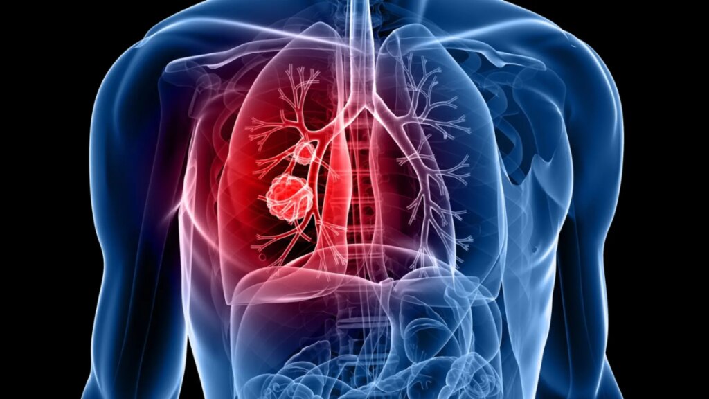 Cáncer de pulmón en personas no fumadoras, por qué aparece: causas, síntomas y prevención