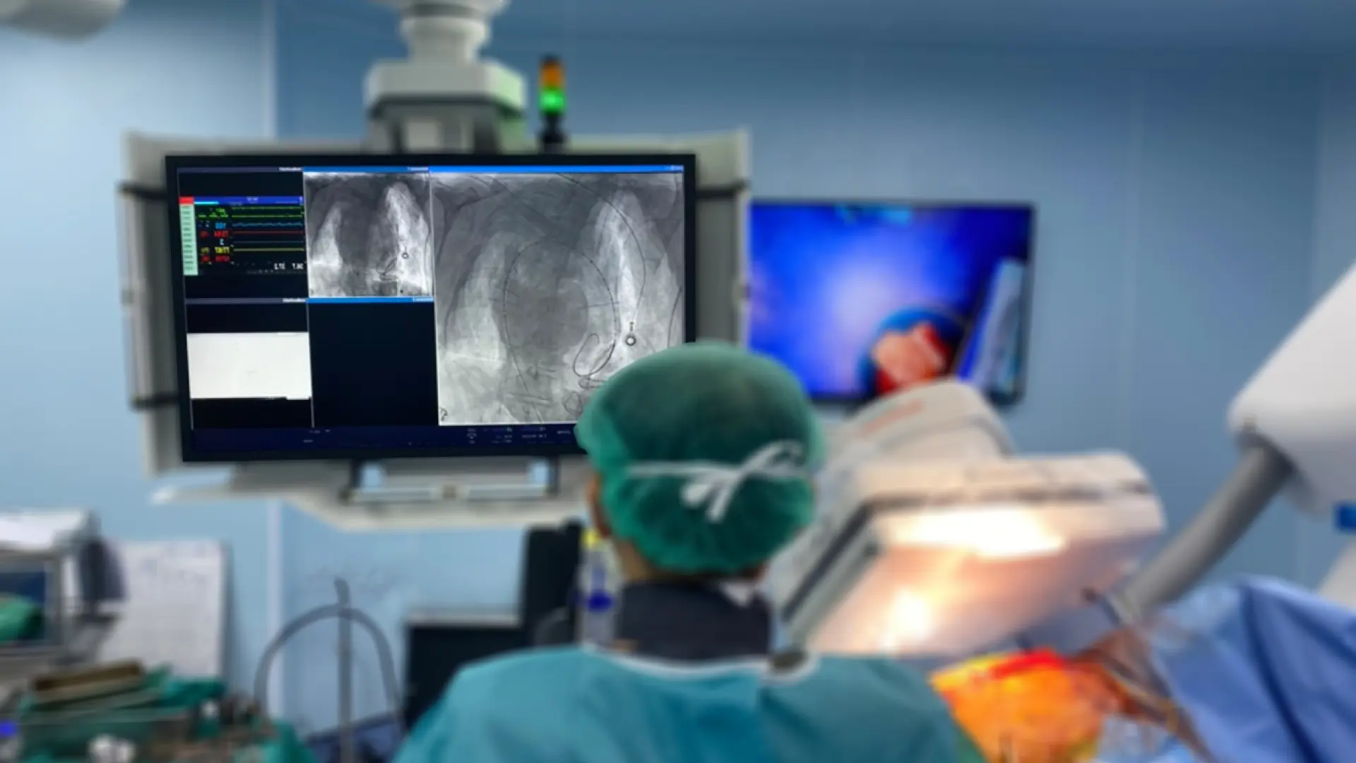Médicos estadounidenses realizan el primer trasplante de pulmón doble totalmente robótico del mundo