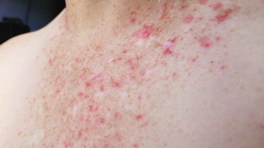 desmontamos cinco creencias erróneas sobre la psoriasis