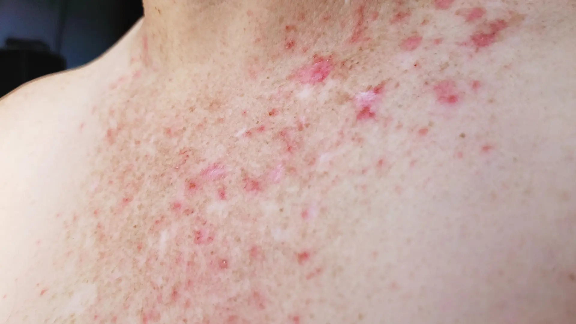 desmontamos cinco creencias erróneas sobre la psoriasis
