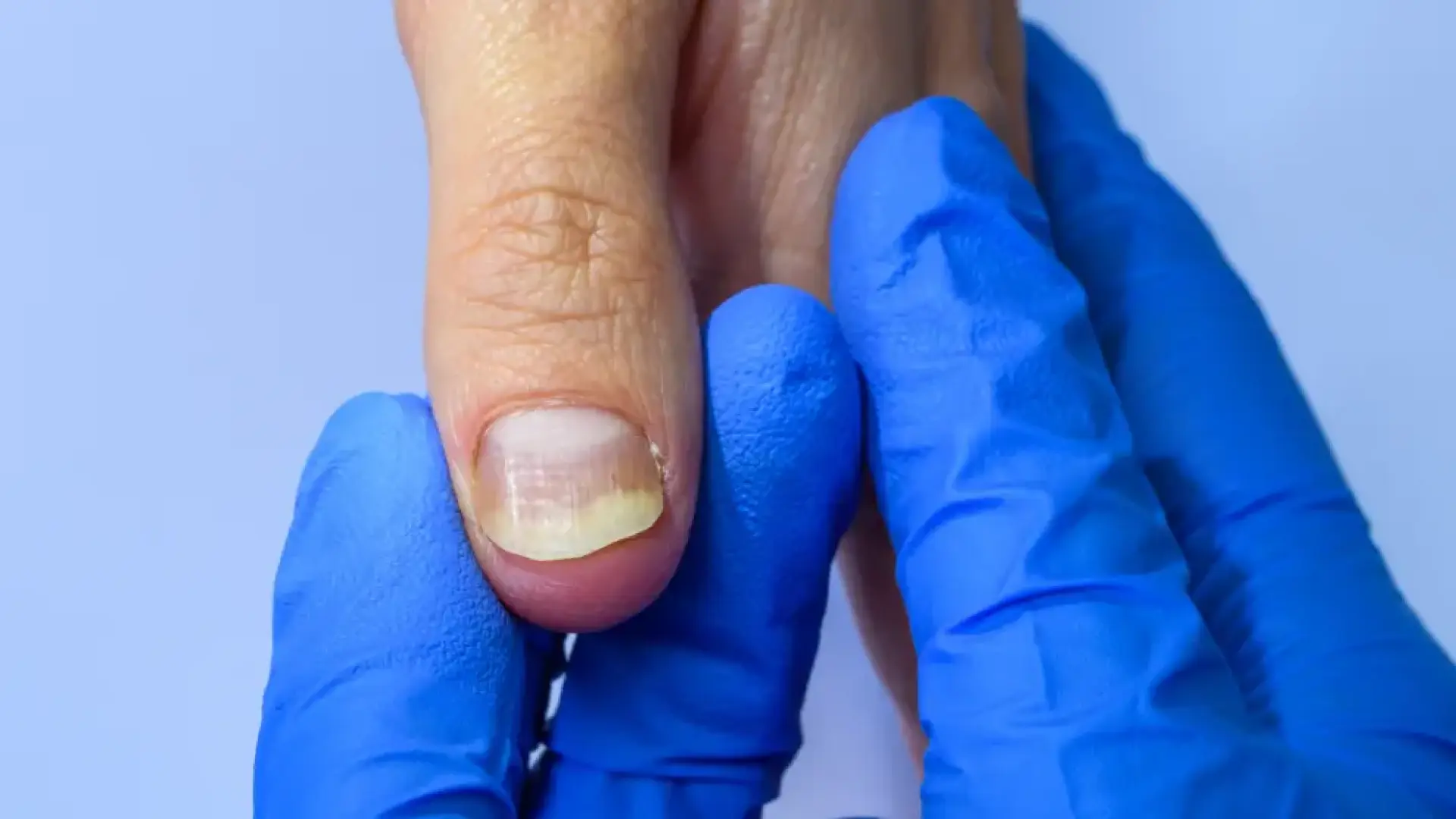 ¿Qué es la psoriasis ungueal? Signos y causas de esta enfermedad de las uñas