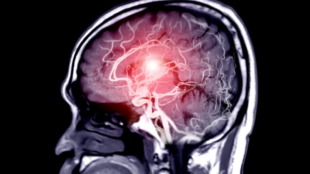Encuentran microplásticos en el bulbo olfatorio el cerebro humano, al que podrían llegar por inhalación