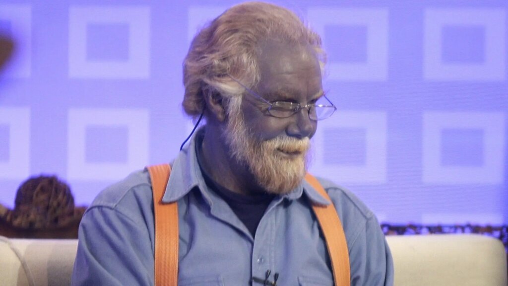 Así es la argiria, la extraña enfermedad que vuelve azul a las personas