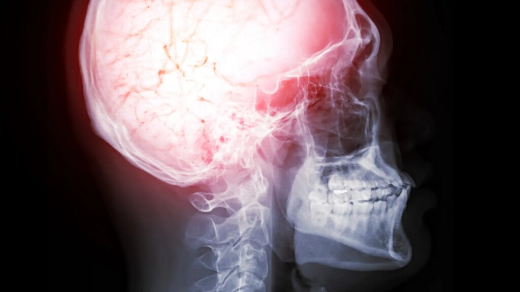 La acumulación de microplásticos en el cerebro podría constituir un factor de riesgo de demencia